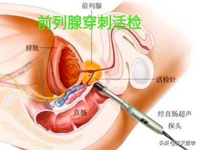 前列腺检查是什么？