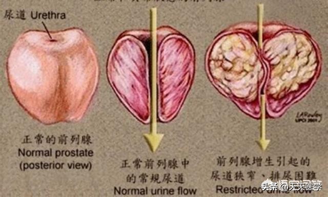 前列腺检查是什么？