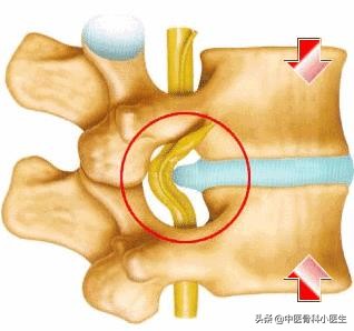 我腰椎间盘突出很严重，生活很受影响，多医院求治无果怎样才能恢复？