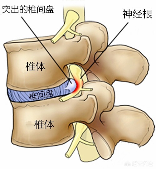 腰椎盘突出能跑步吗？