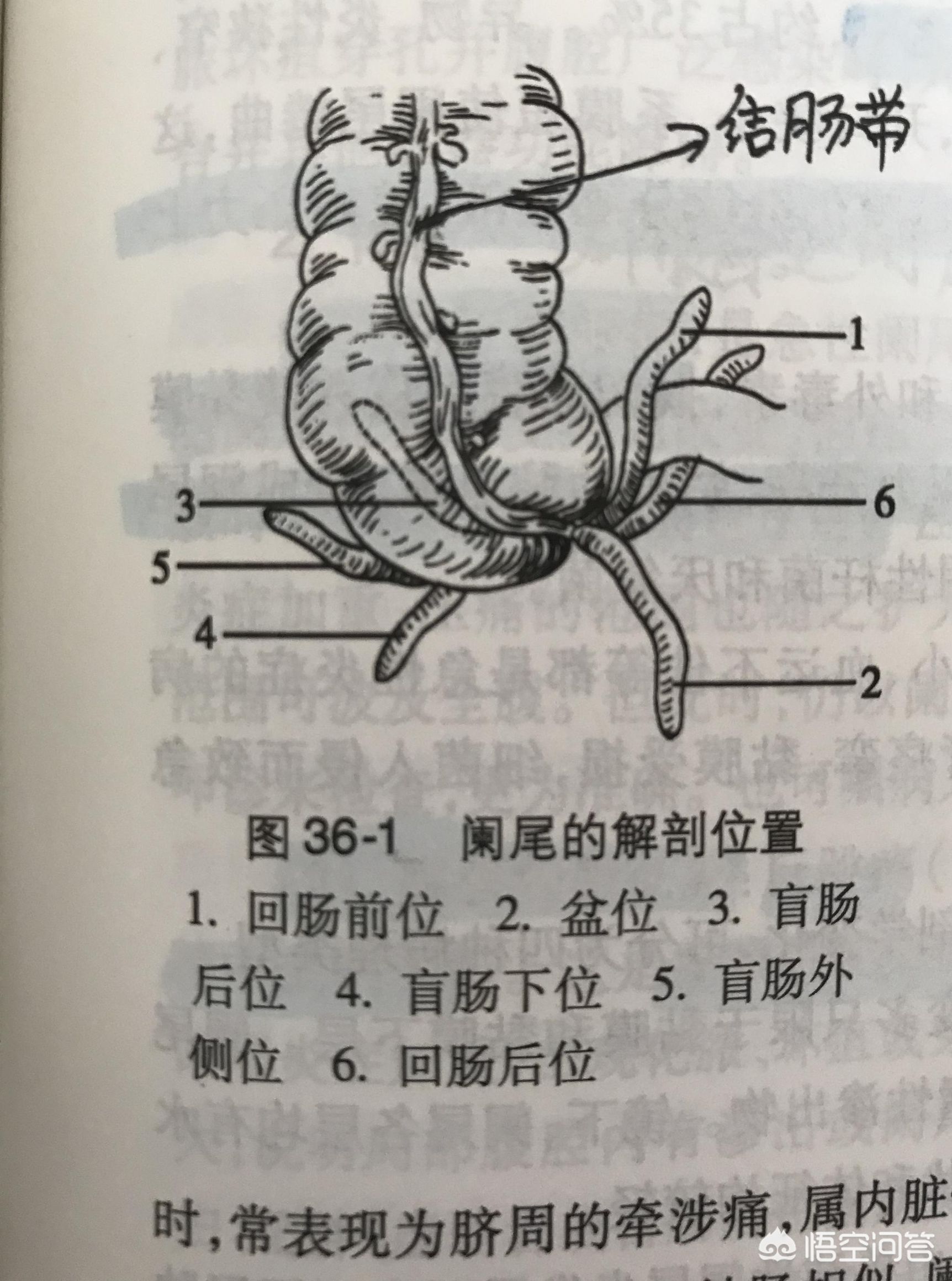 阑尾炎会死人吗？