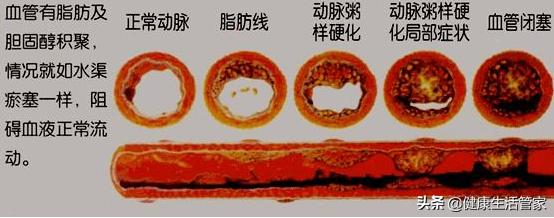 高血脂的人，不想血栓，打死都不要碰的3种食物是什么？