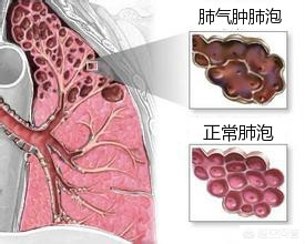 支气管炎和肺气肿的中老年人要注意哪些东西？