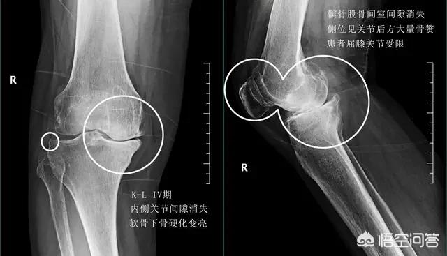 骨关节炎该怎么治疗？