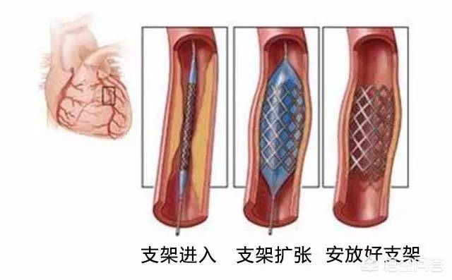 装过心脏支架的人现在感觉如何？是多少岁装的？