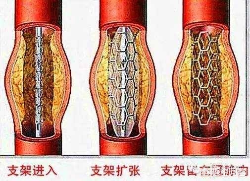 装过心脏支架的人现在感觉如何？是多少岁装的？