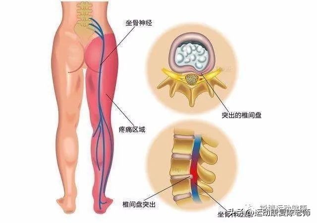 腰椎间盘突出是不是久坐就会引起？