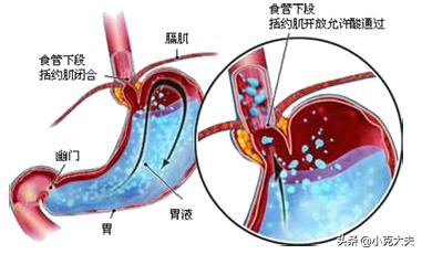 胃酸过多，吃点什么食物或者零食可以减少胃酸？