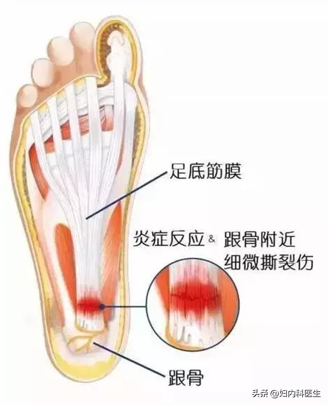 脚底板疼痛是怎么回事？