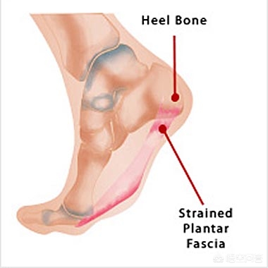 脚底板疼痛是怎么回事？
